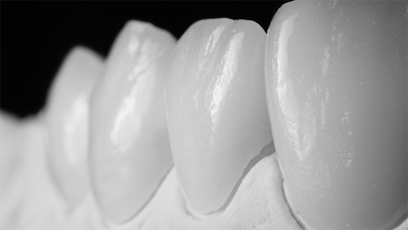 faceta dentaria laminada combinada com prótese dentaria fixa