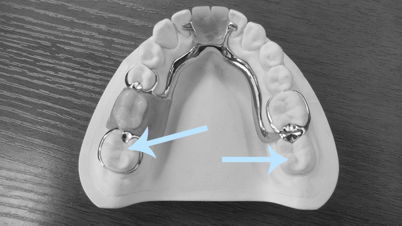 protese dentaria removel grampo metal