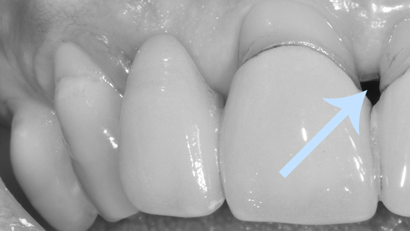 retração gengival prótese dentária