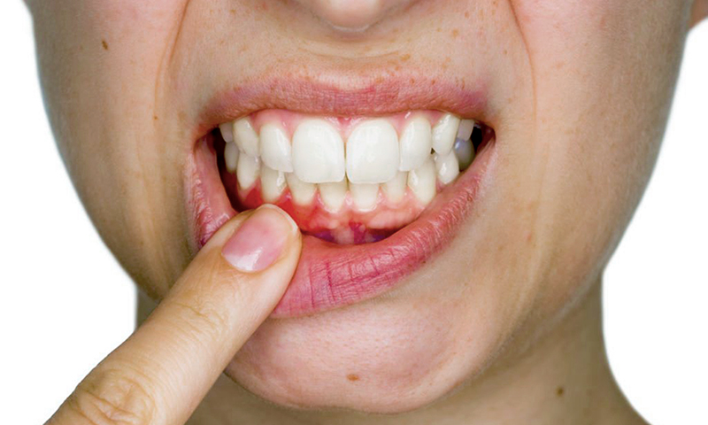 cárie em raiz dentária tratamento