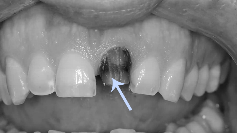protese dentaria dente escurecido