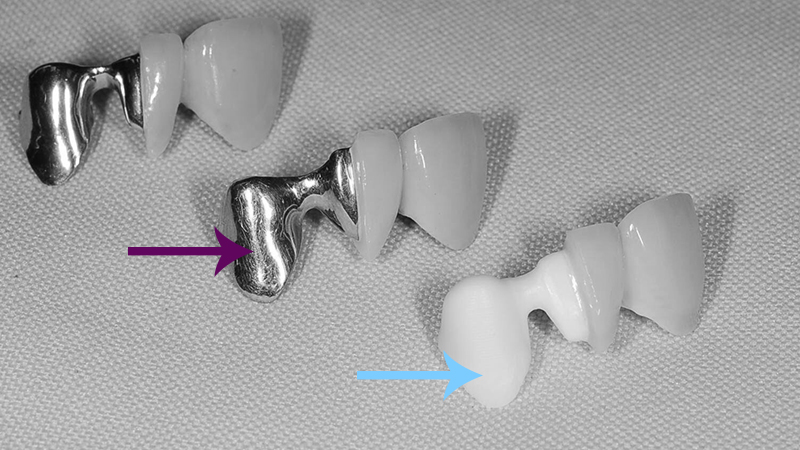 protese dentaria fixa em zircônia com porcelana pura