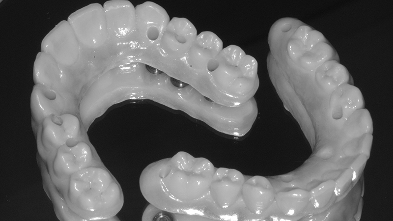 protese dentaria protocolo em porcelana