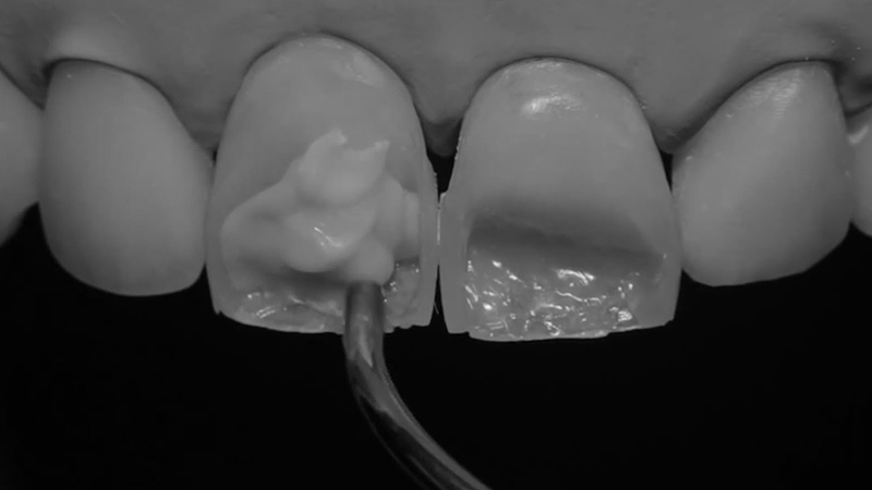 restauração dental direta em resina