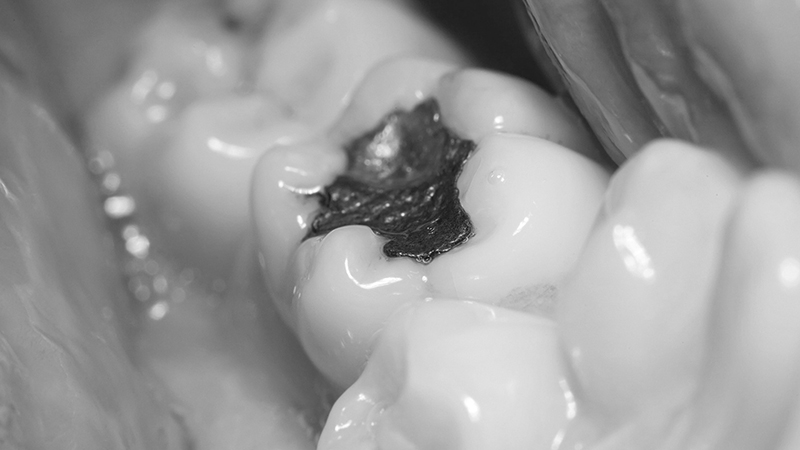 restauração dental em amálgama de prata