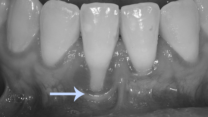 retração gengival dente anterior incisivo inferior