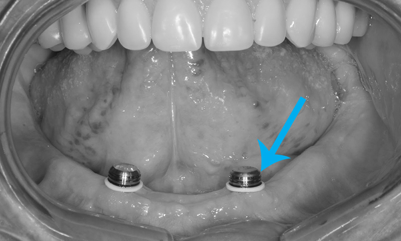 dentadura implante dentário