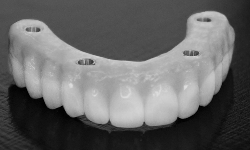 dentadura superior com encaixe sobre implante dentário