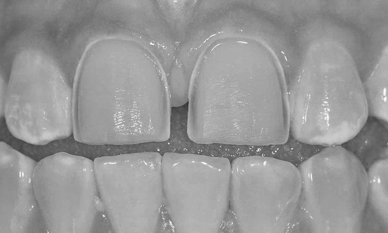 faceta de porcelana desgaste dentário risco e problemas