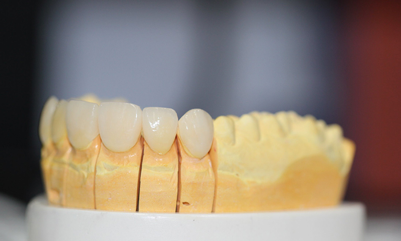 prótese dentária em porcelana
