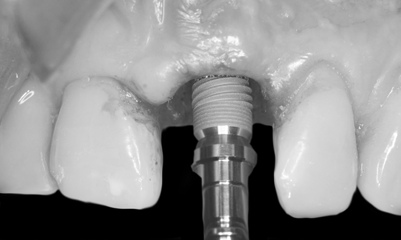 raiz dentaria fraturada com fratura e implante dentário