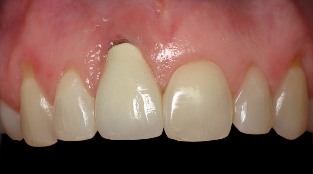 retração gengival implante dentário post blog