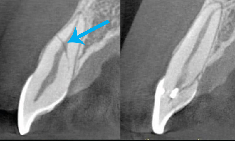 tomografia para raiz dentaria fraturada