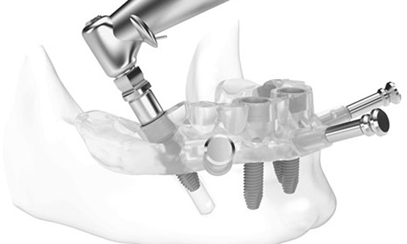 cirurgia sem cortes e pontos implante dentário post blog