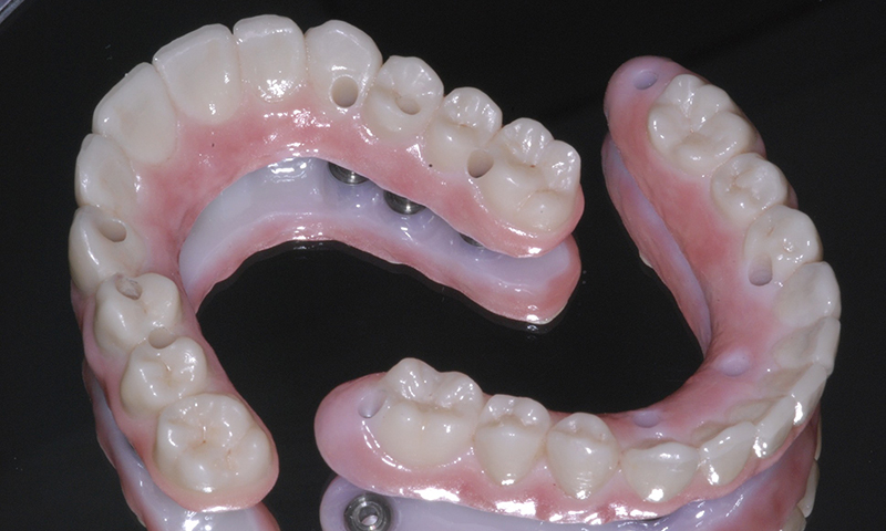 dentadura fixa sobre implante dentário zircônia e porcelana
