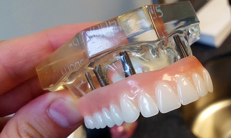número de implantes dentadura fixa post blog