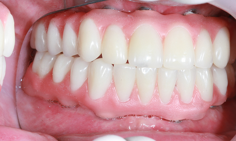 prótese protocolo em resina acrílica e implante dentário