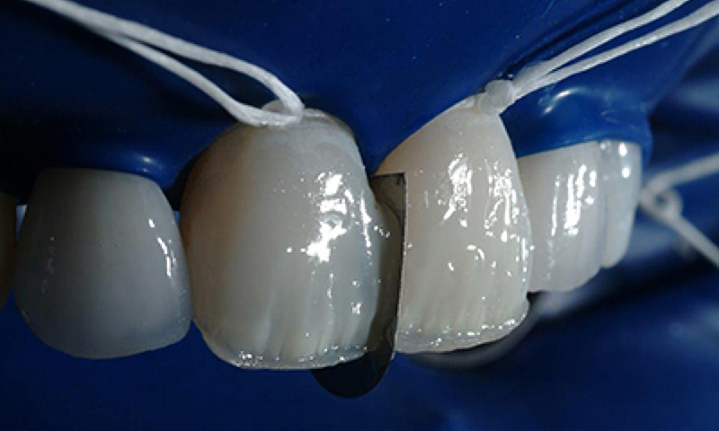 restauração dental em resina