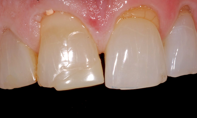 restauração dentária em resina e bruxismo