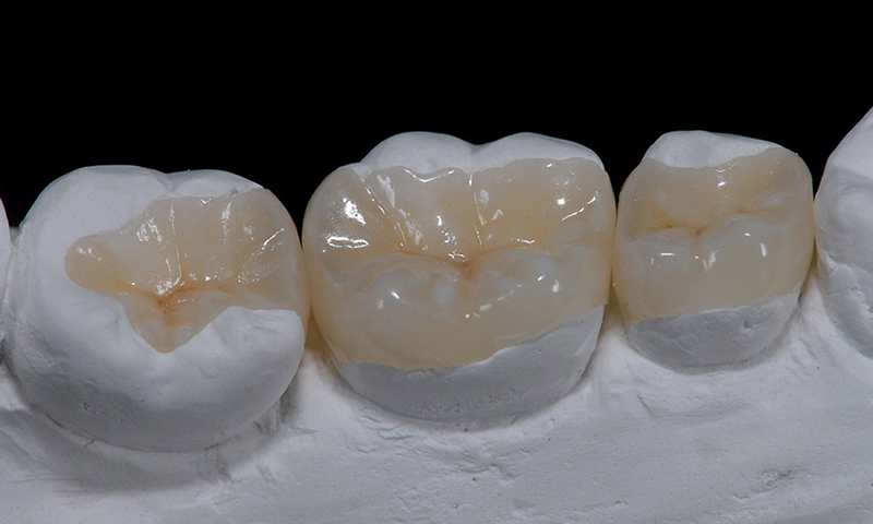 restauração dentária em porcelana