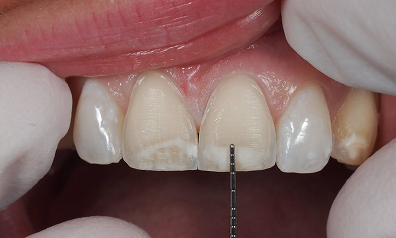 faceta em porcelana desgastes dentários odontologia estética