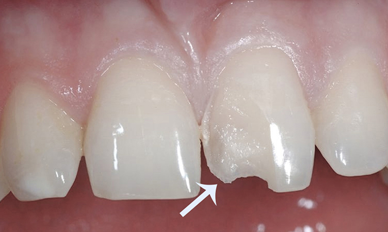 fragmento cerâmico para substituir lente de contato dental