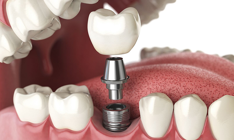 implante dentário em titânio