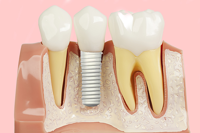 implante dentário em zircônia e estética