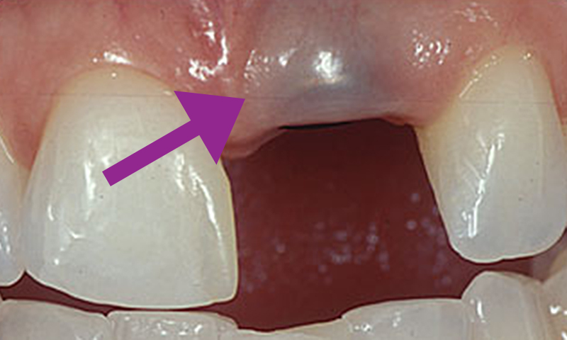 implante dentário gengiva escurecida