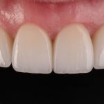 Lente de contato dental pode ser substituída por microabrasão estética.