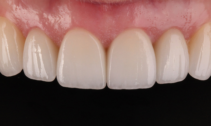 lente de contato dental e microabrasão do esmalte post blog