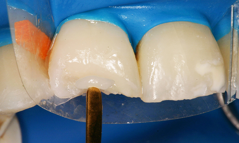 restauração dentária em resina em dentes anteriores