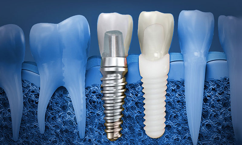 protese dentária protocolo post blog