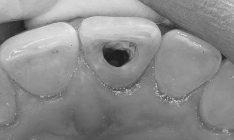 clareamento dental dente escurecido por tratamento de canal