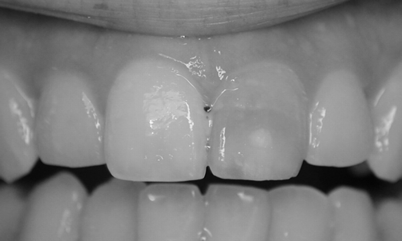 dente escurecido por canal faceta de resina