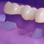Prótese dentária em porcelana tipo pôntico é alternativa ao implante.