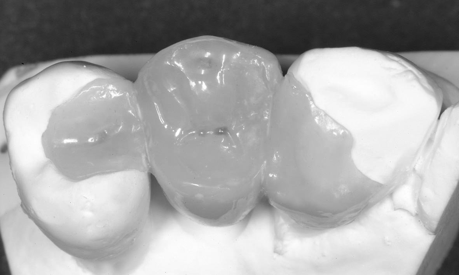 prótese dentária adesiva pôntico