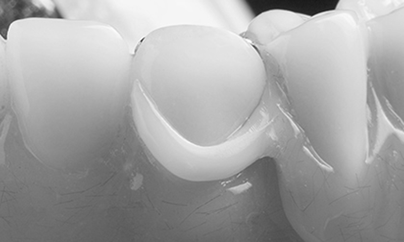 prótese dentária com grampo flexível