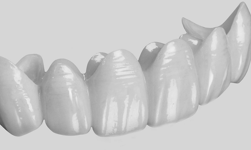 prótese dentária fixa em porcelana pura em pôntico
