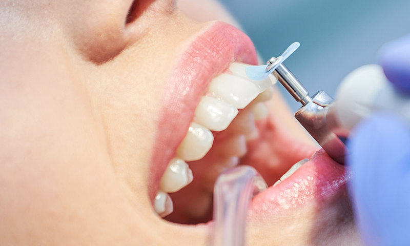 limpeza dental profilaxia post blog