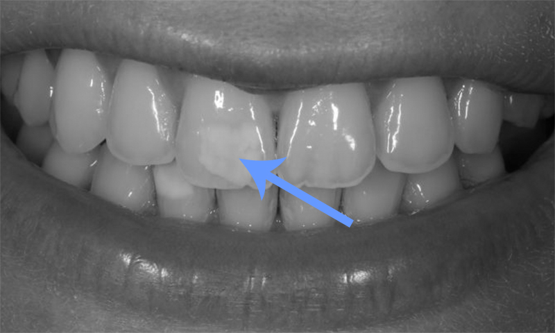 manchas dentárias hipoplasia dental
