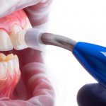 Microabrasão dental: as indicações, prós e contras.
