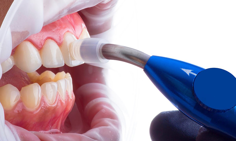 microabrasão dental prós e contras