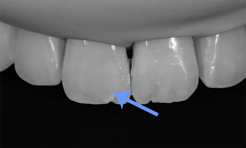 microabrasão do esmalte dental remoção de manchas