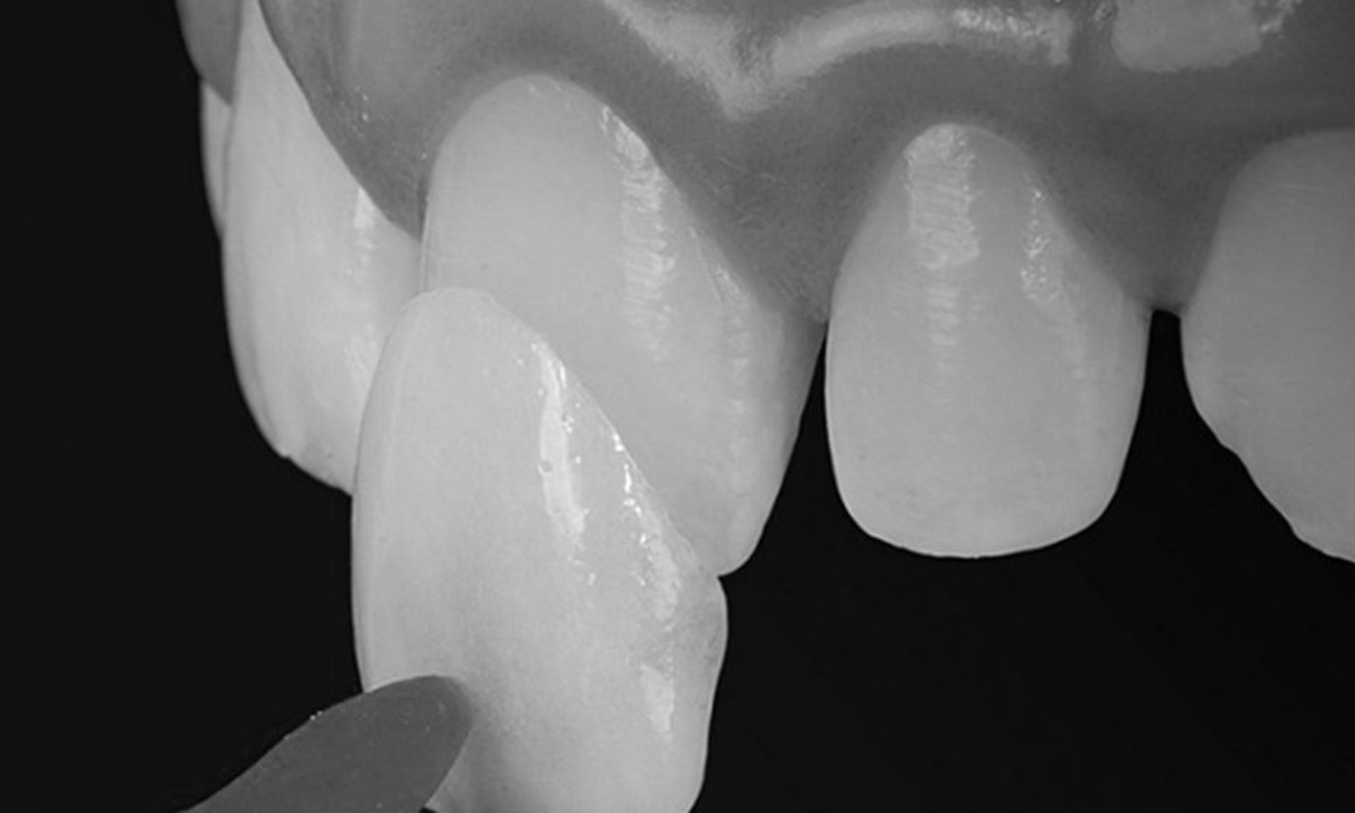 lente de contato dental e prótese dentária fixa