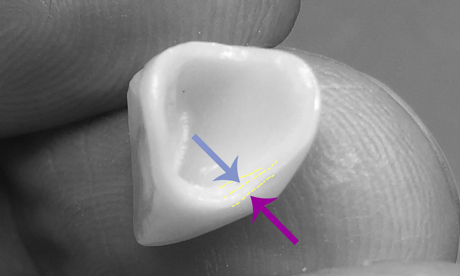 protese dentária fixa em zircônia