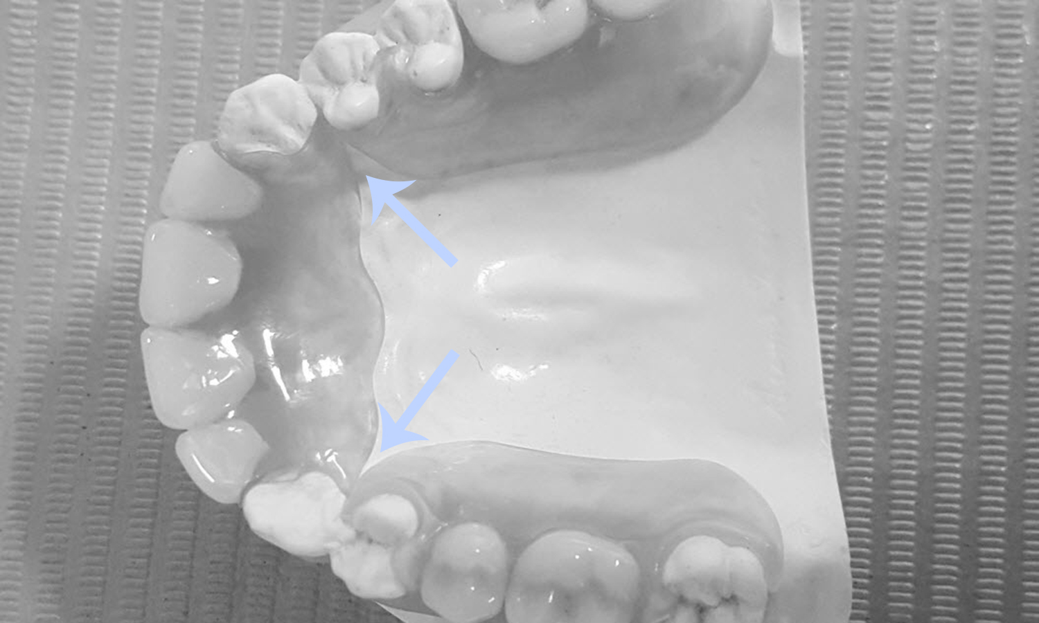 prótese dentária com grampo estético problemas