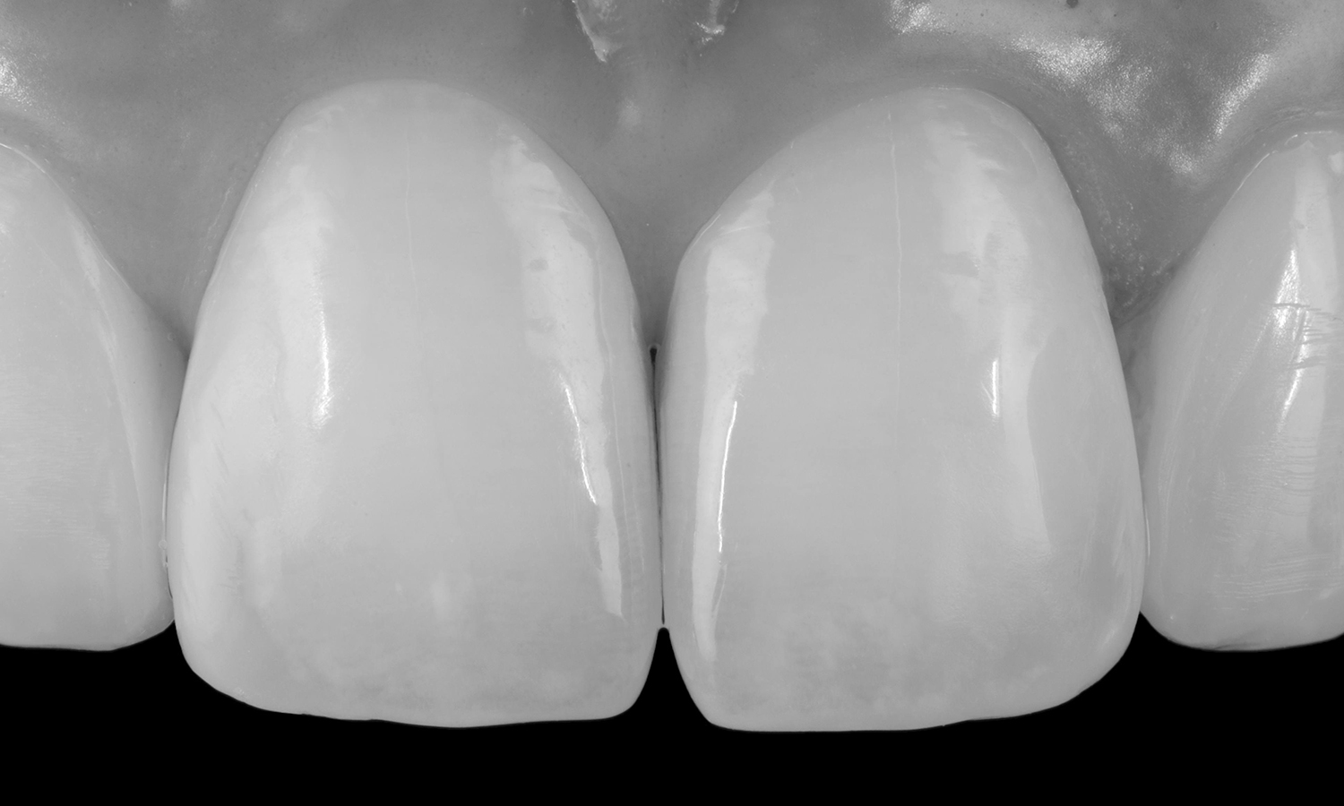 prótese dentária fixa em porcelana pura