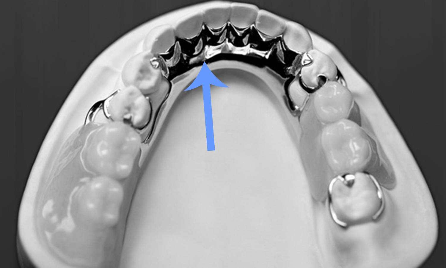 prótese dentária removível com grampo estético