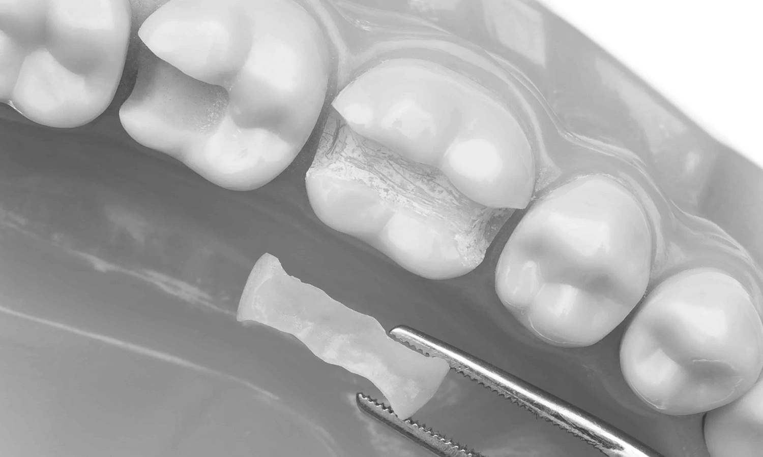 restauração dentária onlay e inlay
